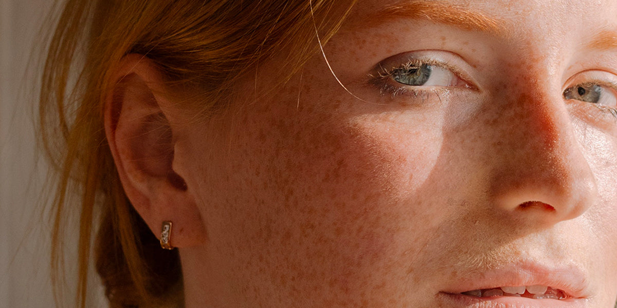 Iperpigmentazione della pelle: consigli e trattamenti efficaci